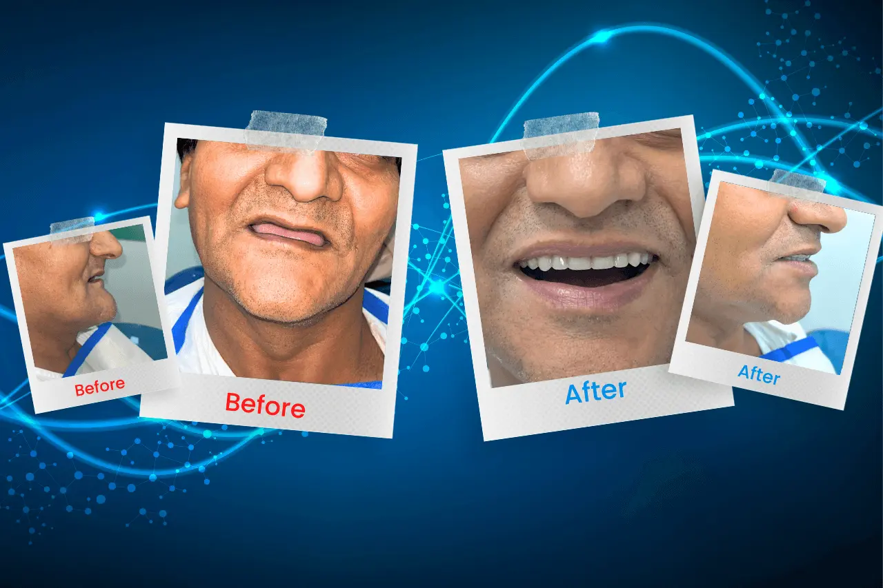 Transforming Smiles with Complete Dentures at SmritiRaj Dentistry